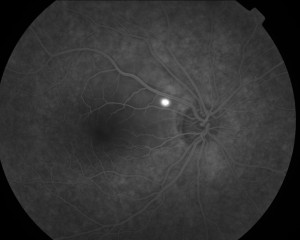 corioretinopatia 