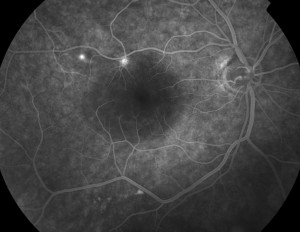 corioretinopatia 