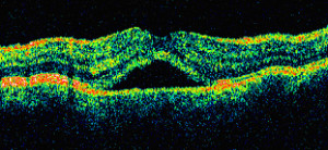corioretinopatia