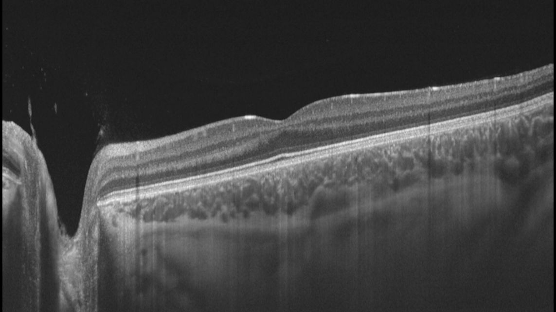 3397721868-figlio_20150307_172912_B-scan_L_001